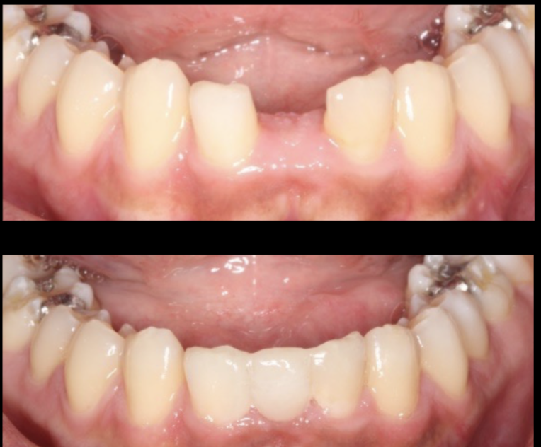 <p>fiber-reinforced composite direct adhesive bridge </p>