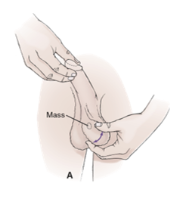 <p>With index and middle finger under testis and thumb on top, roll the testis gently in a horizontal plane b/w thumb and fingers</p>