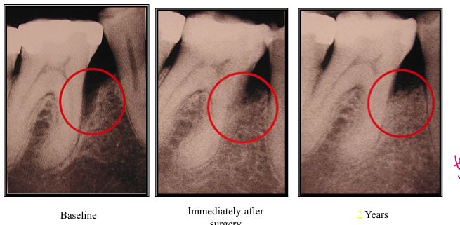 <p>-histologic studies in both humans and animals have often shown that healing after grafting procedures often results with a long JE rather than a new CT attachment</p>