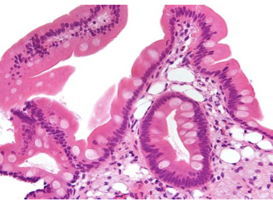 <p>1) Whipple, tropheryma whipplei</p><p>2) </p><ul><li><p>Macrophages PAS+ dans le chorion </p></li><li><p>Villosités distendues et applaties</p></li><li><p>lipodistrophie du chorion (photo) </p></li></ul><p>3) grêle, mais tout le GI peut être touché </p><p>4) PAS+, Ziehl négatif pour le whipple </p>