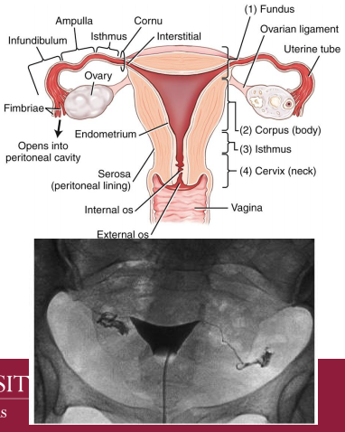 <p>Hysterosalpingogram</p>