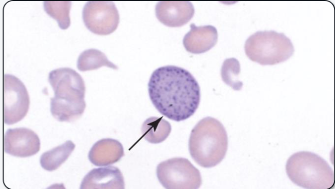 <p>What cellular inclusion is shown? What is it composed of? What anemia is it most associated with?</p>