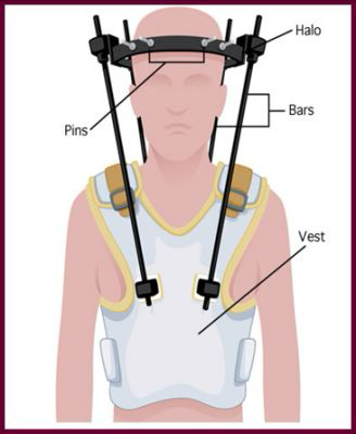 <p></p><ul><li><p>Type of "Cervical Brace" (but also, not really a brace)</p></li><li><p>Pins are going into the cranium to keep the heat perfectly in place</p></li><li><p>Usually reserved for <strong>dens fractures</strong> (but also could be used for another unstable fracture)</p></li><li><p>Patient has this on 24 hours / day and cannot use pillows to sleep</p></li></ul><p></p>