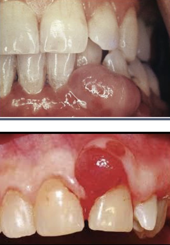 <p><strong>Benign tumors</strong></p><p>- Fibromas</p><p>- Papilomas</p><p>- Peripheral or central giant cell granuloma</p><p>- Leukoplasia</p><p>- Gingival cysts</p><p><strong>Malignant tumors</strong></p><p>- Squamous cell carcinoma</p><p>- Malignant melanoma</p><p>- Sarcoma</p><p>- Metastasis</p>