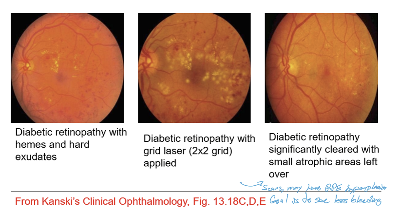 <ul><li><p>Focal laser: Applied to localized leaking microaneurysms or specific retinal breaks.</p></li><li><p>Grid laser: Used for diffuse leakage or diffuse macular edema where focal points can't be targeted individually.</p></li></ul><p></p>