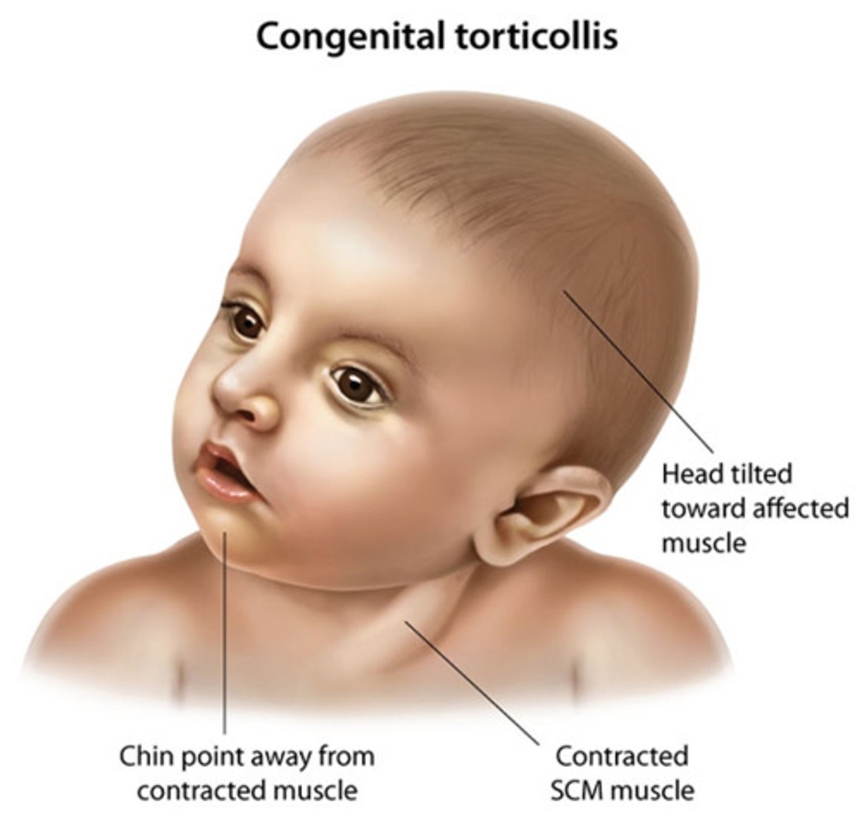 <p>head tipped to one side, chin points to the other side.</p><p>Usually caused by injury to SCM during delivery or from intrauterine positioning/</p>