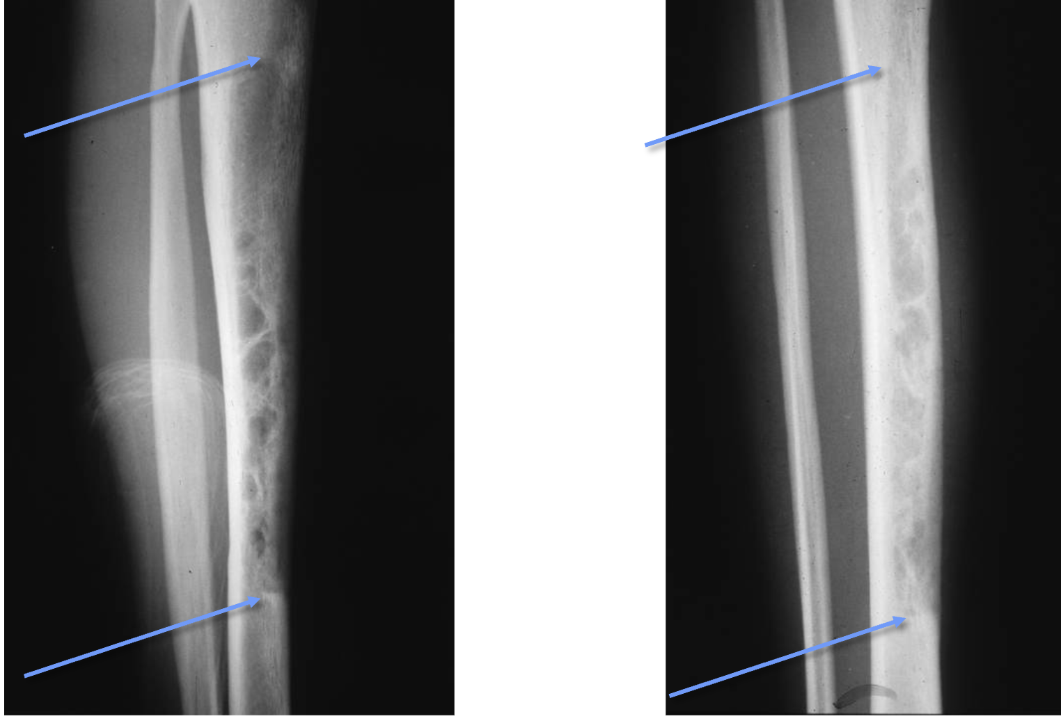 <p>What tumour like disorder is this, what can you see?</p>