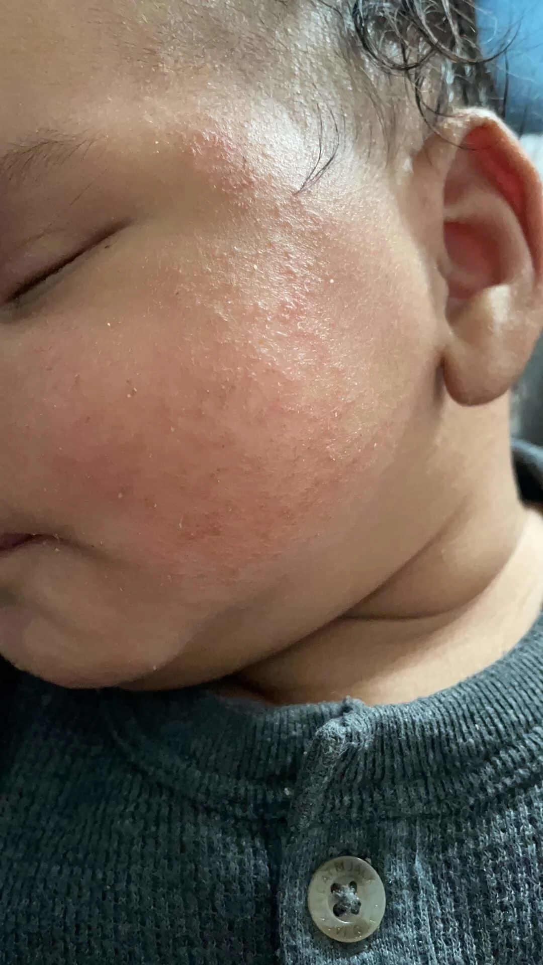 <p>Atopic dermatitis can affect various areas of the body, including the face, neck, wrists, and the bends of the elbows and knees. In infants, it often appears on the scalp and cheeks. </p>
