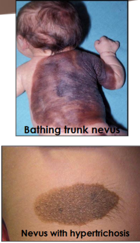 <p>most common on trunk and extremities, 15% in head and neck</p>