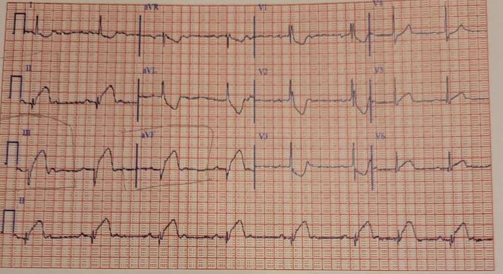 <p>howd yk that was an inferior wall acute MI w injury</p>