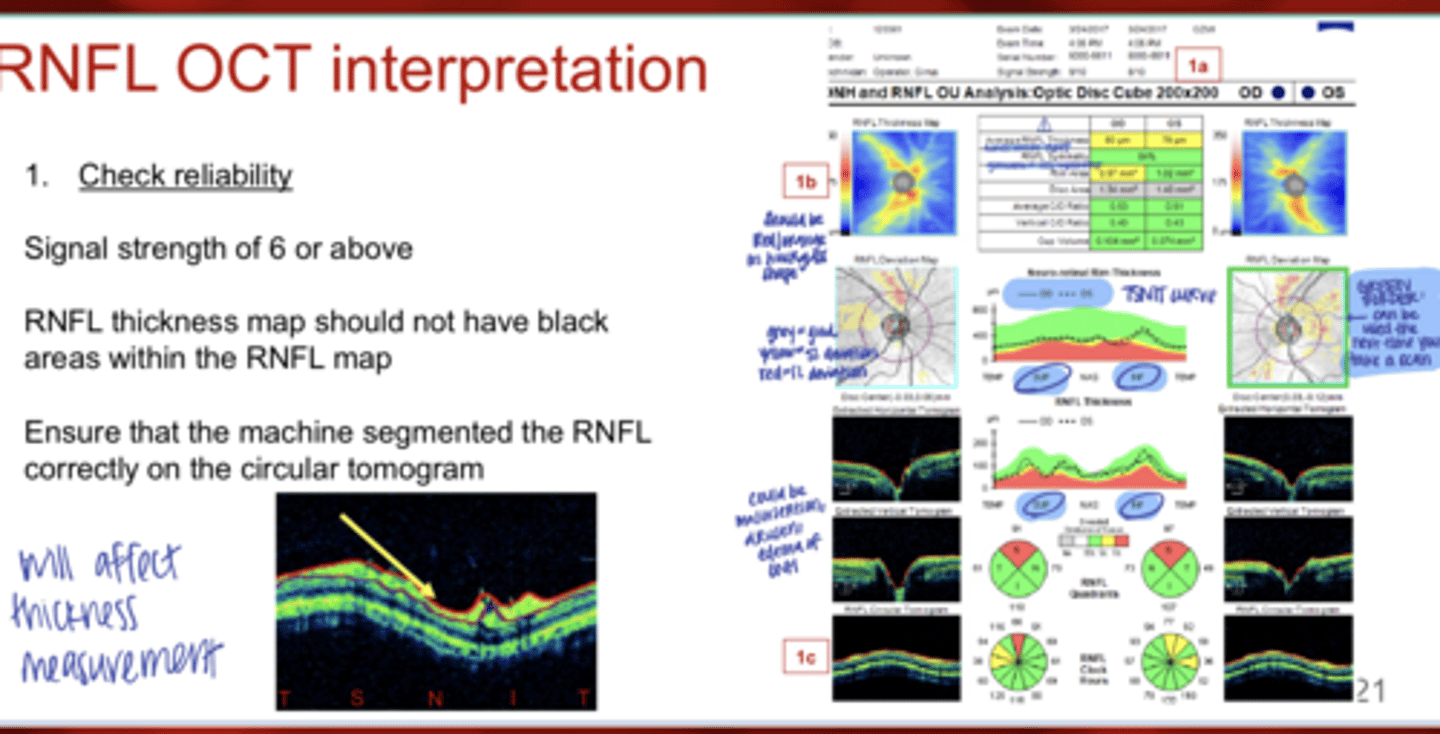 <p>What should you ensure when interpreting OCT RNFL measurement?</p>