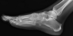 <p>- Inform pts that not all FBs will be visible on plain film (opaque vs lucent)</p><p>- If retained FBs are not removed --> concern for infection</p>