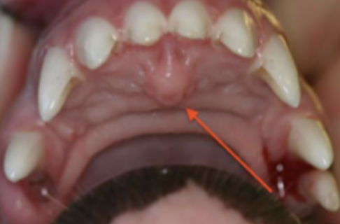 <p>What is the elevation of mucosa at the rostral end of the median line of junction of the halves of the palate, concealing the orifices of the incisive ducts?</p>