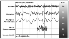 <p>Based on this ECG, is the patient awake or deeply anesthetized?</p><p>-High voltage, slow oscillations, "synchronized", dose dependent</p>