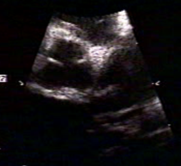 <ul><li><p>Aneurysmal Coronary Arteries</p><ul><li><p>may be lined w/ thrombus</p></li><li><p>>3mm <5 y/o</p></li><li><p>>4mm >5 y/o</p></li></ul></li><li><p>may affect myocardial perfusion</p><ul><li><p>causes WMA’s</p></li></ul></li><li><p>MR + AI</p></li></ul><p></p>