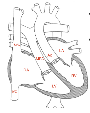 <ul><li><p><span style="color: red;">2 wrong connections</span></p><ul><li><p><u>atria are connected to the wrong ventricles</u></p></li><li><p><u>ventricles are connected to the wrong great vessels</u></p></li><li><p>overall connection is “correct”</p><ul><li><p><strong>“Congenitally Corrected”</strong></p></li><li><p><strong>“Double Discordance”</strong></p></li><li><p>unsaturated bl→RA→LV→PA</p></li><li><p>saturated bl→LA→RV→Ao</p></li></ul></li></ul></li><li><p></p></li></ul><p></p>