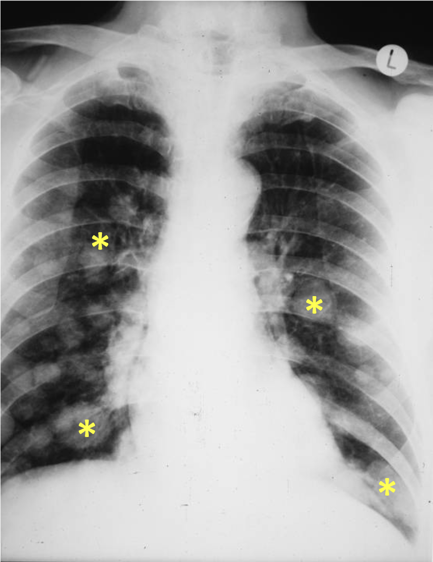 <p>What tumour like disorder is this? What are the yellow asterixis showing?</p>