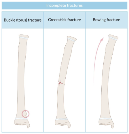 <p>Bowing: Bone bending + no break</p><p>Buckle/Torus: Bone compressing + no break</p><ul><li><p>Compressed side = Buckling deformity</p></li><li><p>Tension side = Intact</p></li></ul><p>Greenstick: Bone bend (1 side) + bone break (1 side)</p><ul><li><p>Compressed side = Intact</p></li><li><p>Tension side = Break</p></li></ul><p></p>