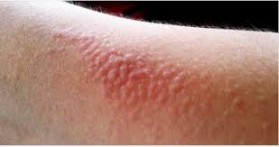 «Сурьмяная чесотка» — специфический дерматит при контакте с пылью вещества [END]