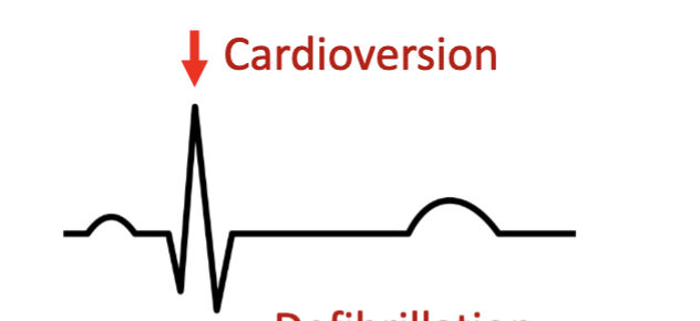 <p><mark data-color="#db9e5b" style="background-color: rgb(219, 158, 91); color: inherit;">• Timed with the R wave of QRS to avoid inducing V-fib</mark></p><p>• Used for organized tachyarrhythmias</p><p>(atrial fibrillation/flutter, supraventricular tachycardia, stable</p><p>VT)</p><p>• The shock coordinated with the R</p><p>wave may depolarize the entire heart,</p><p>allowing it to reenter the cardiac</p><p>electrical cycle together and reenter</p><p>normal rhythm</p>