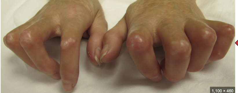 <p>Thickening and tightening of the skin of the fingers.</p>