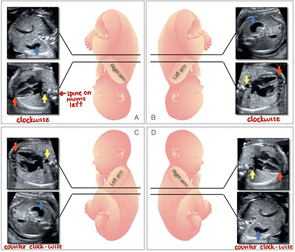 <ul><li><p>determine fetal lie and rotation</p></li><li><p><span style="color: red;">used to ensure heart is. incorrect position and orientation</span></p></li><li><p>fetal lie:</p><ul><li><p>vertex</p></li><li><p>breech</p></li><li><p>transverse </p></li></ul></li><li><p>fetal rotation:</p><ul><li><p>supine</p></li><li><p>prone</p></li><li><p>RT/LT side up or down</p></li></ul></li></ul><p></p>