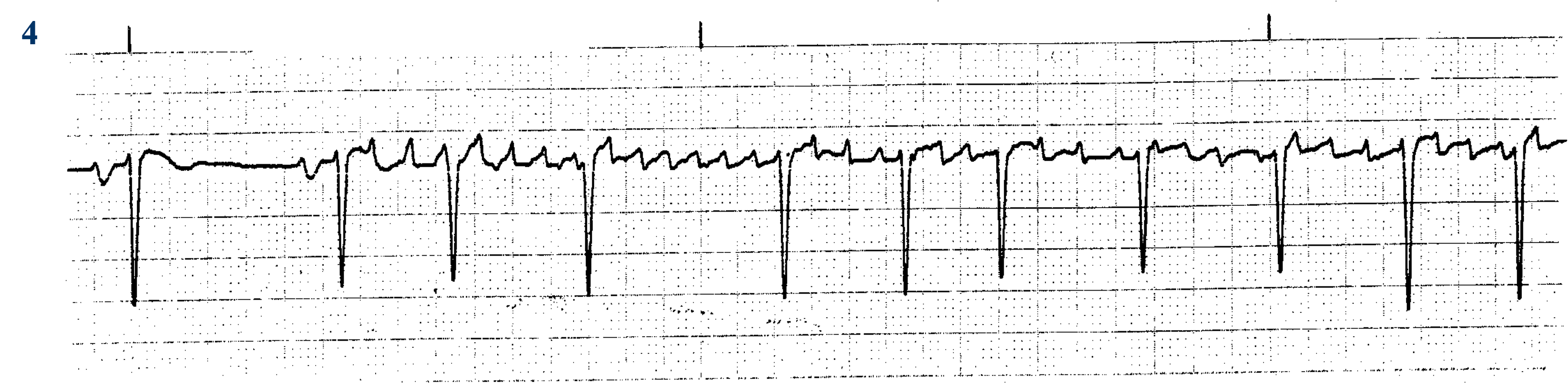<p>What ECG is this? </p>