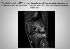 <p>Intra-osseous edema</p>