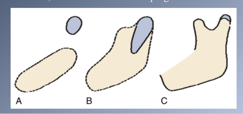 <p><span>1. EMBRYO:</span><br><span>• Mandible develops in the same area as the cartilage of the first pharyngeal arch, Meckel’s cartilage.</span><br><span>• Development begins as a condensation of mesenchyme lateral to Meckel’s cartilage.</span></p><p><span>EMBRYO:</span><br><span>• Meckel’s cartilage disintegrates and largely disappears as the bony mandible develops</span><br><span>• Condylar cartilage develops initially as an independent secondary cartilage, separated by a considerable gap from the body (A)</span><br><span>• Early in fetal life, it fuses with the developing mandibular ramus (B)</span></p>