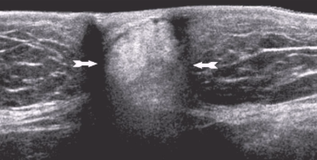 <ul><li><p><span style="background-color: transparent;">Contents compressed → compromised blood supply → ischemia, necrosis, obstruction</span></p></li><li><p><span style="background-color: transparent;">Increased mortality &amp; morbidity</span></p></li><li><p><span style="background-color: transparent;">US appearance&nbsp;</span></p><ul><li><p><span style="background-color: transparent;">Thickened bowel wall, absent vascular flow, free fluid, no peristalsis</span></p></li></ul></li></ul><p></p>
