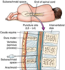 <p>lumbar puncture</p>