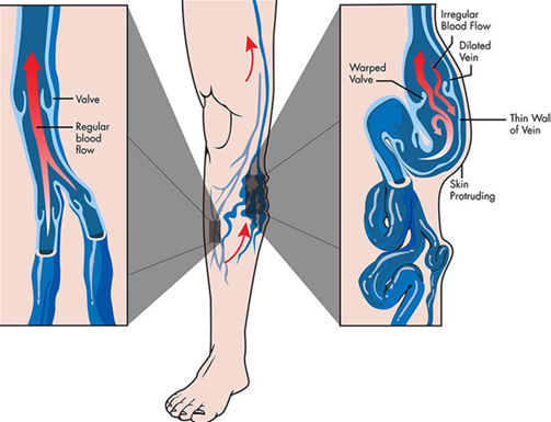 <p>DVT/obstruction or deep valvular incompetence </p>