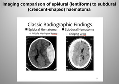 <p>Subdural (subarachnoid) hematoma</p>
