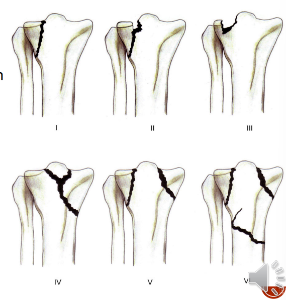 <ul><li><p>common mechanism = valgus/varus force with axial loading</p></li><li><p>high energy (most common pattern = spilitting) = MVA or sport injuries</p></li><li><p>low energy = insufficiency fractures, associated w soft tissue injuries (falls in elderly → osteoporosis → typically depressed #’s)</p></li></ul><p></p><p>Schatzer’s classification of tibial plataeu #’s:</p><ul><li><p>Schatzker 1 → lateral split</p></li><li><p>Schatzker 2 → lateral split w depression</p></li><li><p>Schatzker 3 → lateral depression</p></li><li><p>Schatzker 4 → medial depression</p></li><li><p>Schatzker 5 → bicondylar</p></li><li><p>Schatzker 6 → fracture of both condyles + shaft involvement</p></li></ul><p></p>