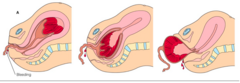 <p>- Usually within 2-10 minutes</p><p>- Uterus becomes globular in shape and firm</p><p>- Uterus rises upward in abdomen</p><p>- Umbilical cord lengthens</p><p>- Sudden gush of blood</p>