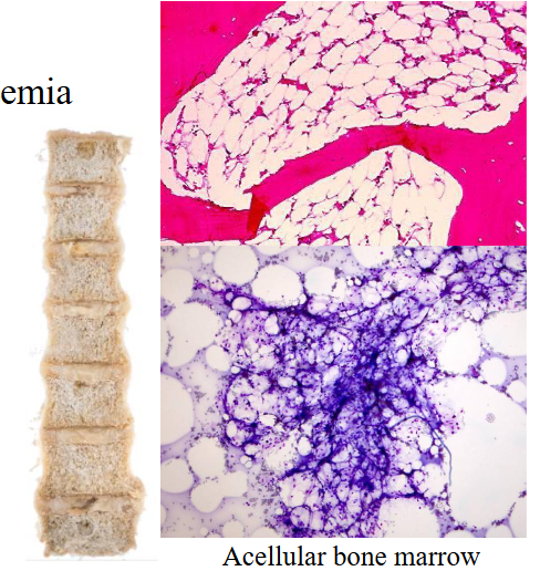 <p>- Pancytopenia due to bone marrow failure</p><p>- Hypoplastic or aplastic bone marrow</p><p>.</p><p>Cause:</p><p>- Congenital: Fanconi anaemia</p><p>- Acquired: Idiopathic, Chemotherapy, Chemicals/toxins, Infections</p><p>.</p><p>- a means without</p><p>- plasia means to make</p><p>- bone marrow should be red, but the diagram shows its full of fat (making it yellow). it should be full of cells. this is clearly the bone marrow of someone whos deceased</p>