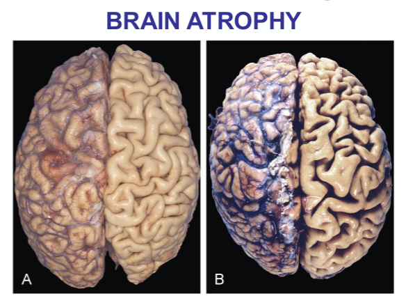 <p>Atrophy is a <strong>decrease</strong> in cell <strong>size</strong></p><ul><li><p>Normal example: <strong>thymus gland</strong></p></li><li><p>Patholo1gical examples: <strong>muscles, brain</strong></p></li></ul><p></p>
