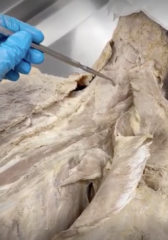 <p>Name the Muscle</p><p>- most superficial layer of posterior neck</p><p>- most medial of the layer</p><p>- same layer has both splenius capitis and cervicis</p>
