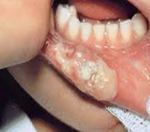 <p><strong>Complication</strong> – After administration of local anesthesia, the pt bites lip and/or tongue while anesthetized</p>