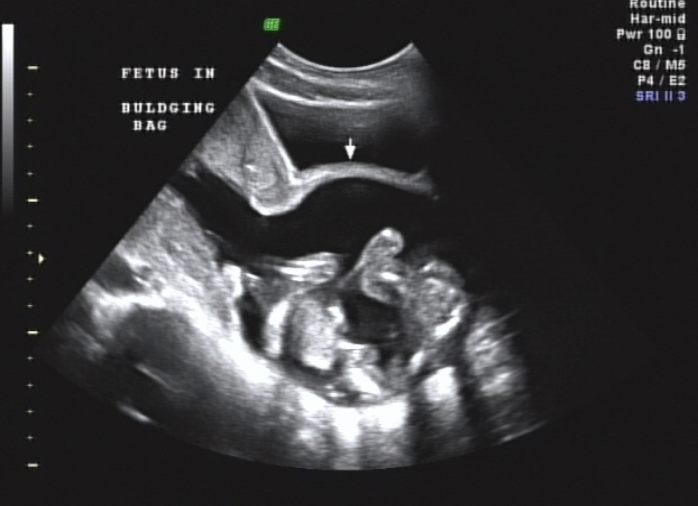 <ul><li><p>cervix may open and allow fetus to pass into vaginal canal → Bulging Bag (BBM)</p></li><li><p>Hour-glassing</p></li><li><p>If enough cervix remains, a cerclage may be put in place to “stitch” the cervix closed in effort to prevent Preterm delivery (PTD)</p><ul><li><p>would not place cerclage in the presence of major fetal anomaly, PROM, infection or placental abruption</p></li></ul></li></ul><p></p>