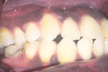 <p><strong>aka: </strong><span style="color: red;">black pigmentation</span></p><p>dark pigmented plaques in the oral cavity</p><p>people have discernible degree of melanin pigmentation distributed throughout the epidermis of the skin/mucosa</p>