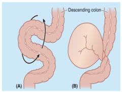 <p>Rotations and twisting of the mobile loop of the sigmoid colon:</p>