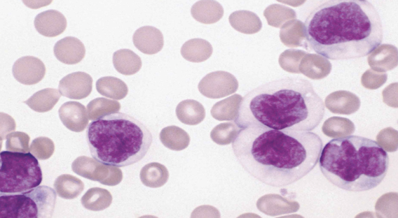 <p>Monoblasts and promonocytes and neutrophil precursors seen </p>