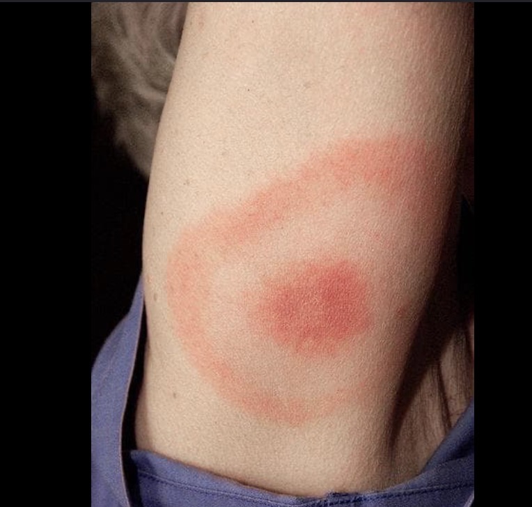 <ul><li><p>rings</p></li><li><p>Ex: erythema multiforme, bullseye rash</p></li></ul><p></p>