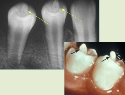 <p>elongated “cusp” extending from central occlusal surface, mand premolars/ maybe molars, usually has pulp tissue, occlusal trauma is a problem </p>