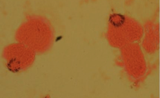 <ul><li><p>protoscolex of echinococcus </p></li><li><p>causes Secondary Hydatid Disease (anaphylactic shock) </p></li></ul><p></p>
