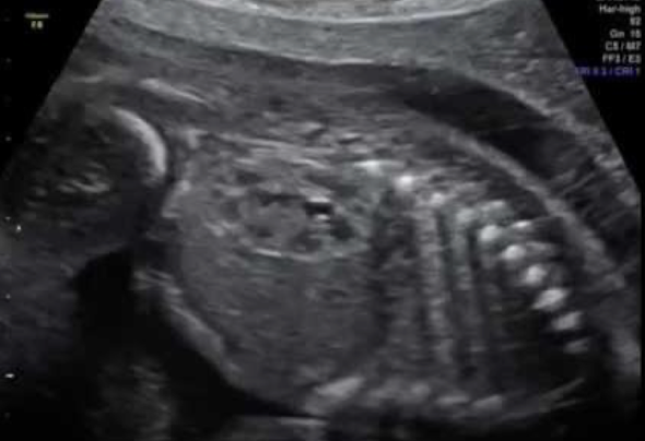 <ul><li><p><span style="color: red;">homogeneous cortex</span></p></li><li><p><span style="color: red;">hypoechoic pyramids</span></p></li><li><p><span style="color: red;">anechoic collecting system</span></p></li></ul><p></p>