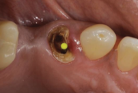 <p>The nail head of post should extend _____ outside the canal</p>