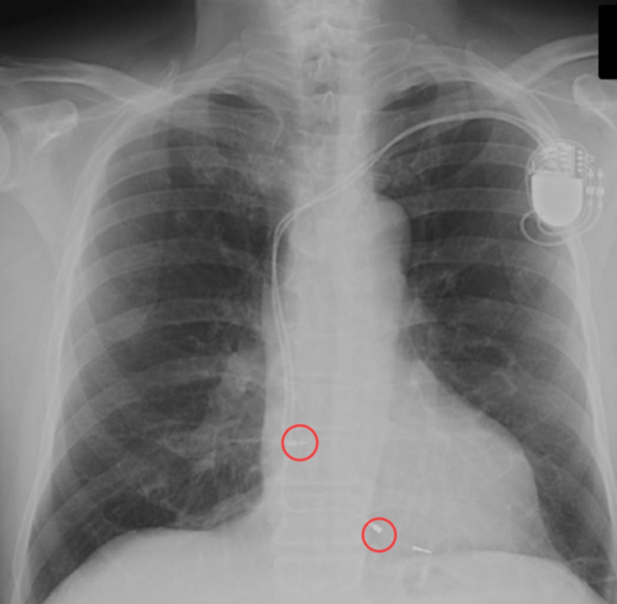 <p>keep heart beating</p><p>temporary or permanent</p><p>often 2 electrodes (RA and RV)</p><p>x-ray after surgery to ensure correct placement</p>