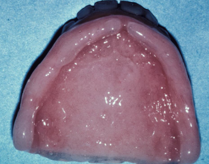 <p>What is an indication for using soft reline material for an interim denture?</p>